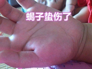 <strong>被蝎子蛰了的土方法被蝎子蛰了不处理有事吗蝎子蜇伤了怎么办</strong>